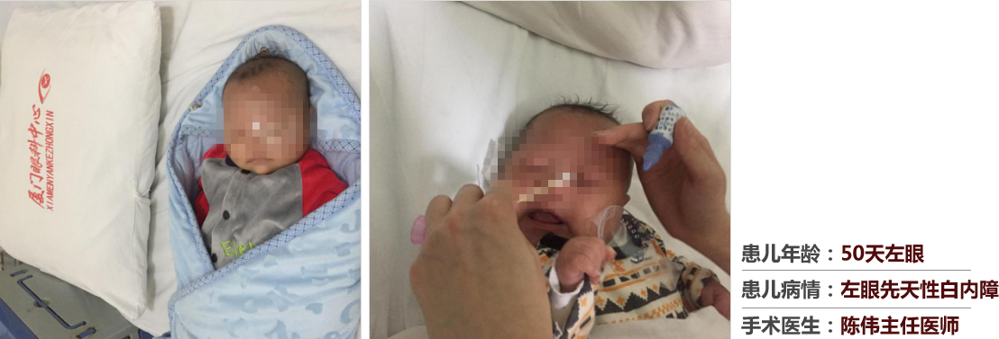 患兒年齡：50天左眼，患兒病情：左眼先天性白內(nèi)障，手術(shù)醫(yī)生：白內(nèi)障科陳偉主任醫(yī)師